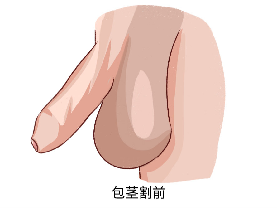 包茎割前割后图