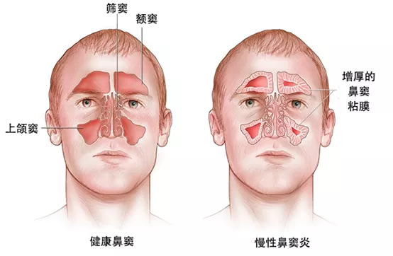 鼻窦炎怎么治最有效的方法