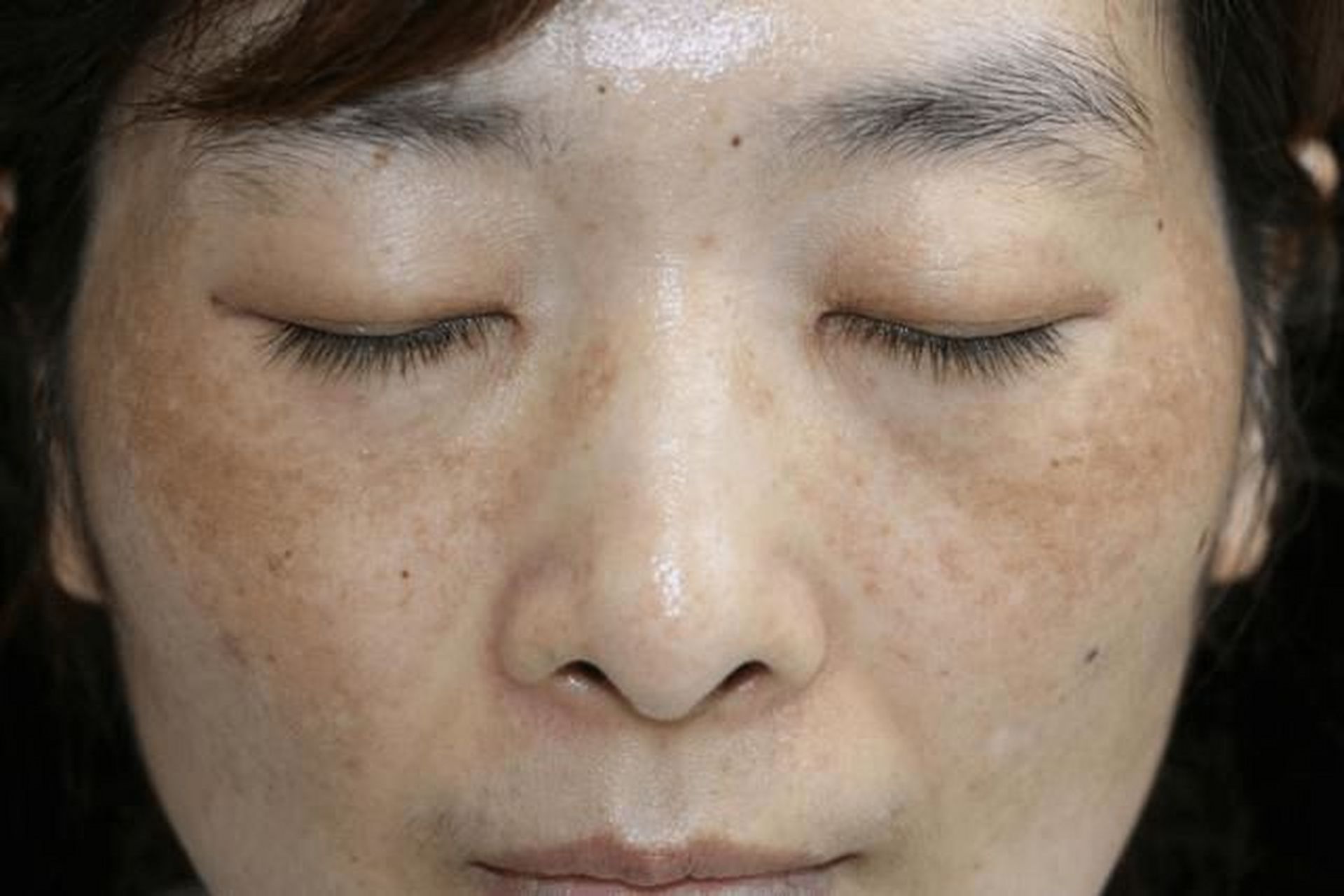 黄褐斑怎么治疗最好