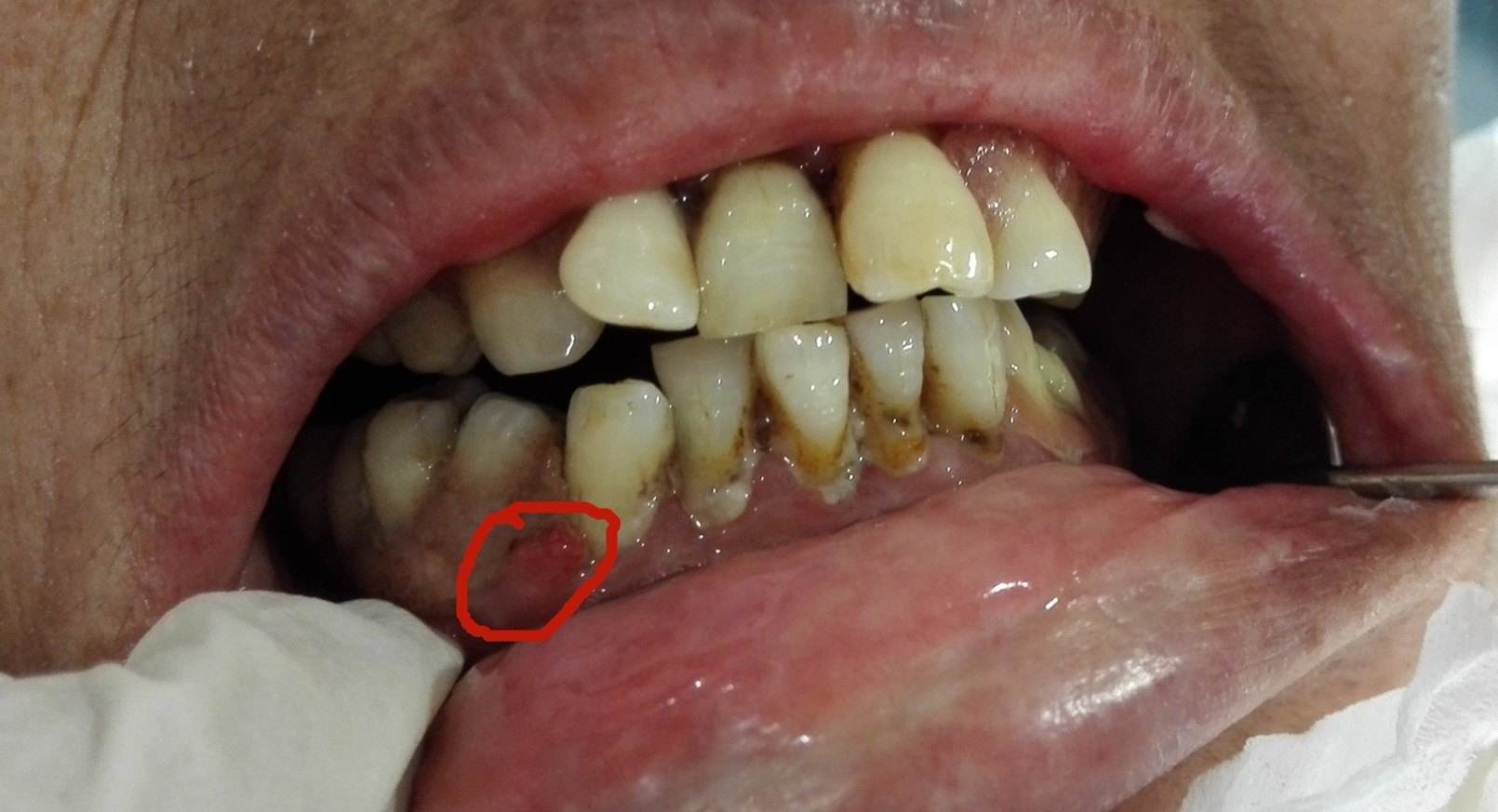牙龈发炎肿痛:牙龈发炎肿痛的治疗方法