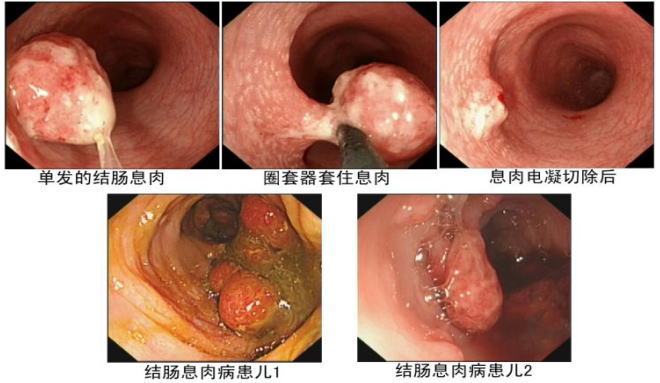 痔疮和息肉区别图片
