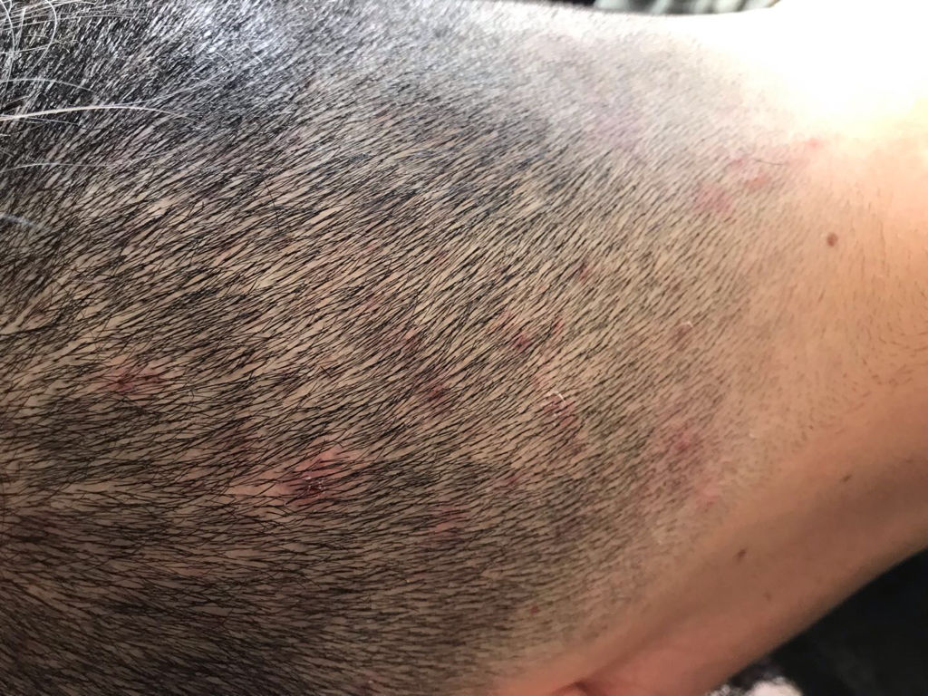 头上长红疙瘩的症状 头上长红疙瘩原因