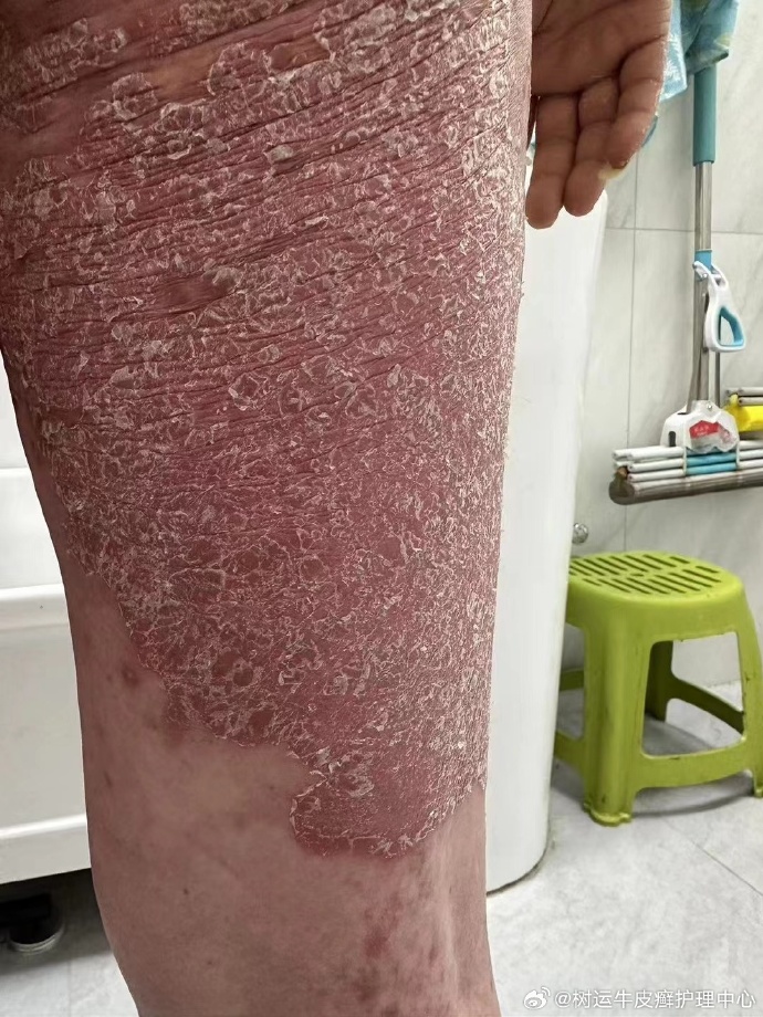 银屑治疗最好方法