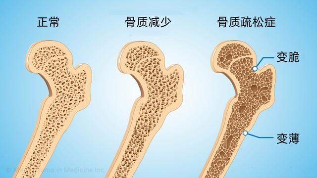 骨密度低有什么症状