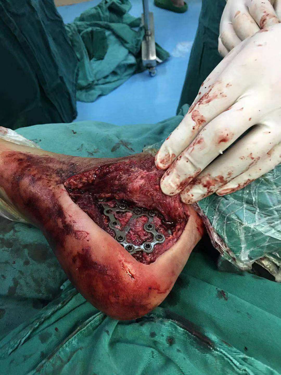 骨折需要忌口什么东西