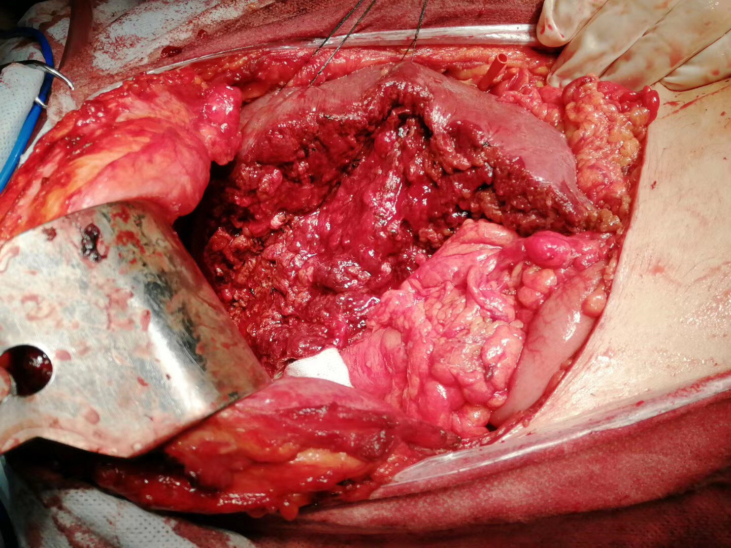男子腹泻1年肝脏脓肿竟因吃路边摊
