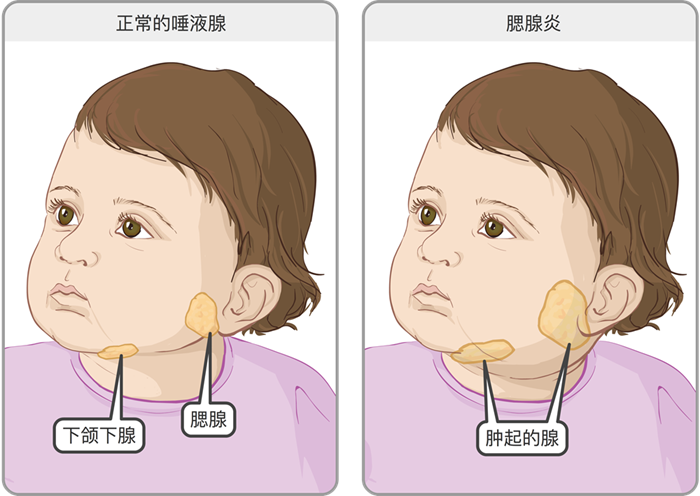 腮腺炎疫苗有必要打吗