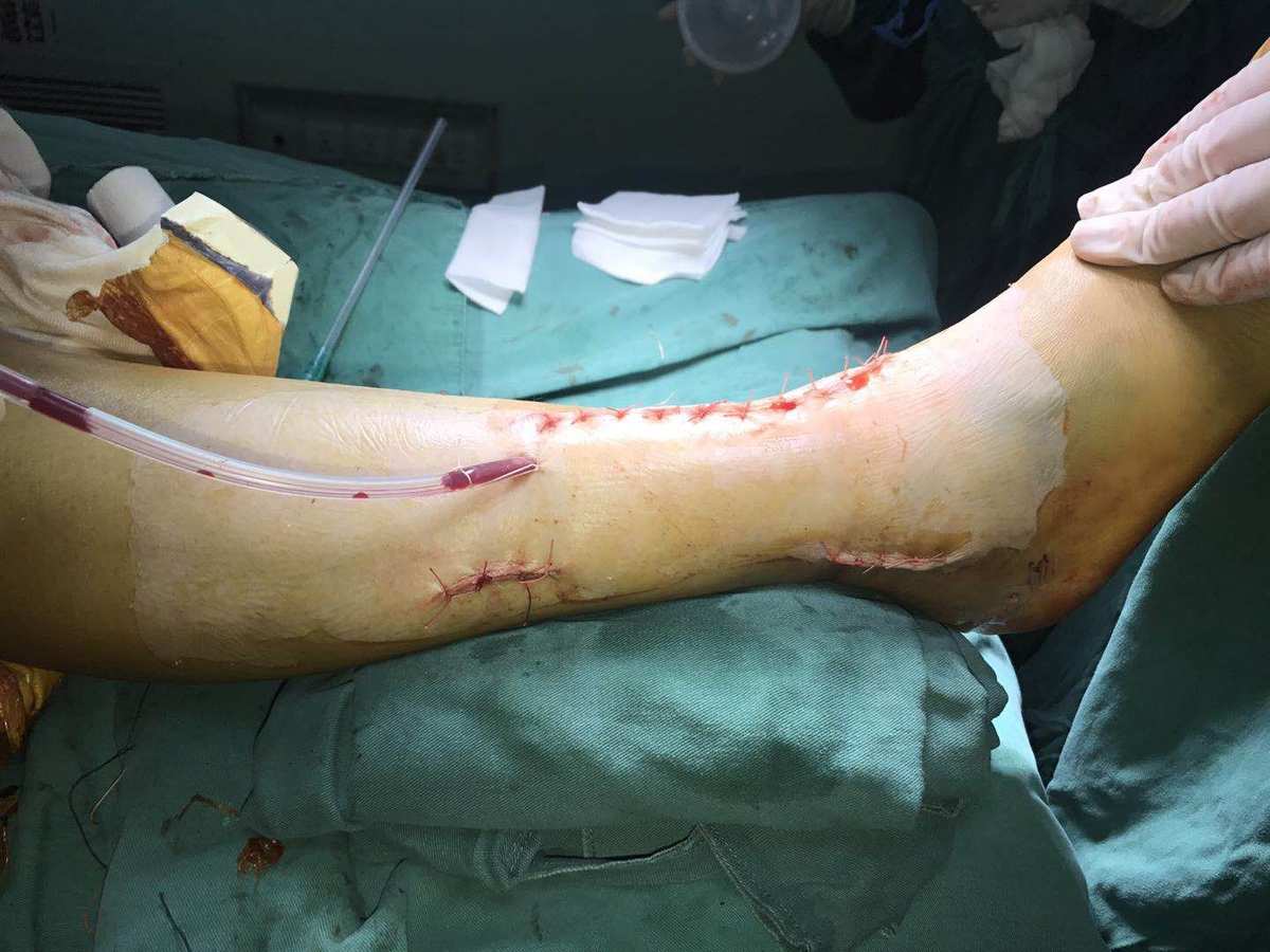 骨折的病人吃什么补钙