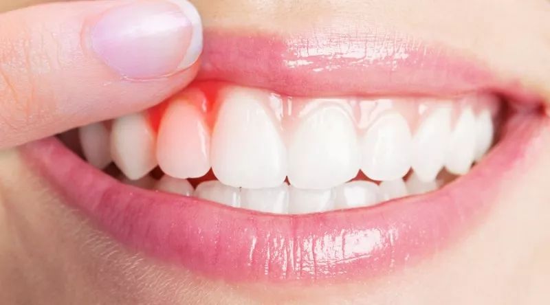 牙龈出血吃什么好 牙龈出血的食疗方法