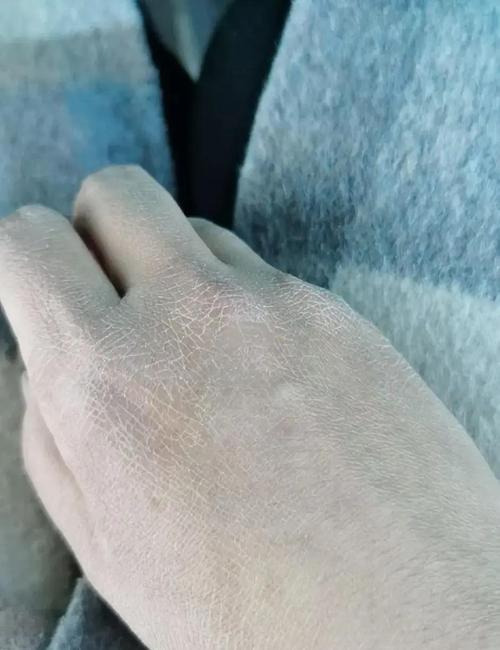 肾不好的5大信号 肾功能下降的表现症状 肾不好的5大信号 肾功能下降的表现症状