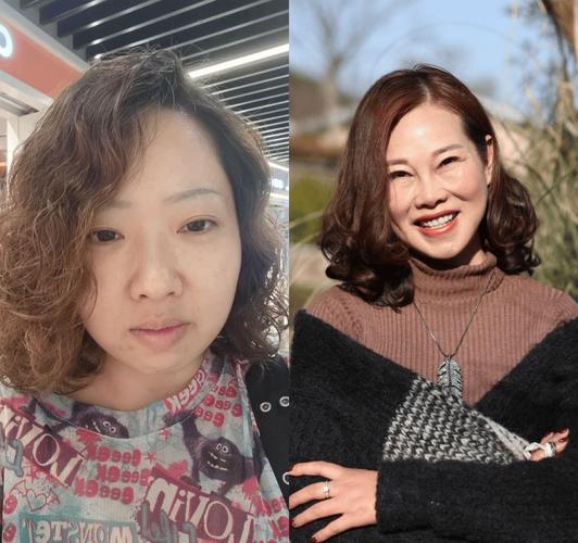 针灸美容法有哪些特点 总结其三大特点 针灸美容法有哪些特点 总结其三大特点