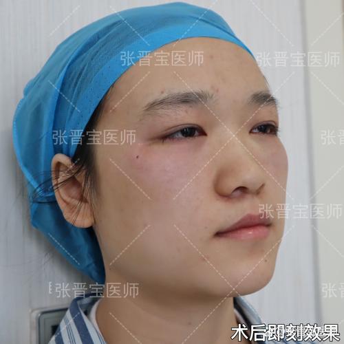 咬肌大怎么办 咬肌大怎么办