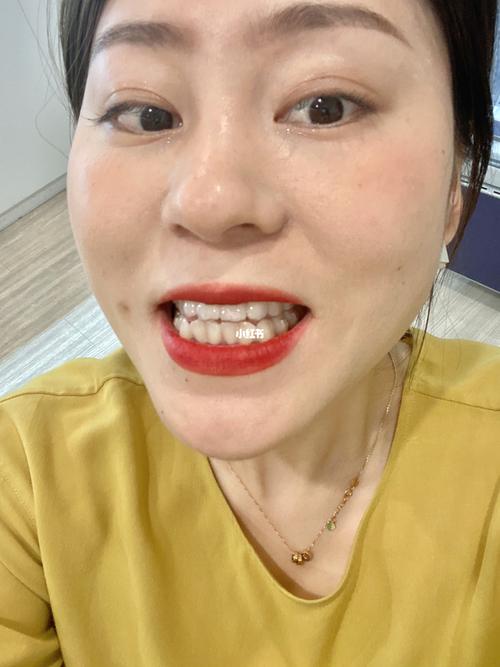 眼底黄斑叶黄素可以抑制吗 叶黄素的作用有哪些 眼底黄斑叶黄素可以抑制吗 叶黄素的作用有哪些