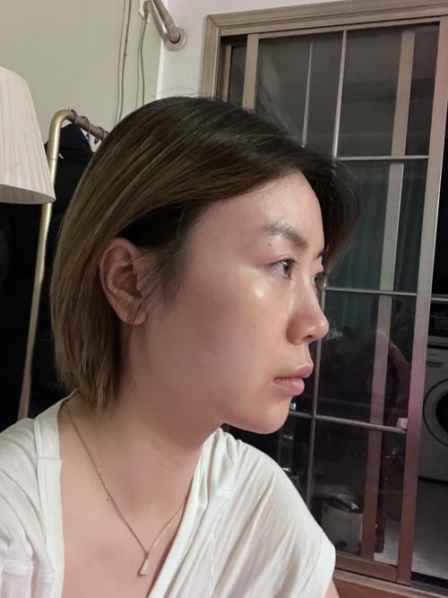 治疗油脂脱发需要多少钱 治疗油脂脱发需要多少钱