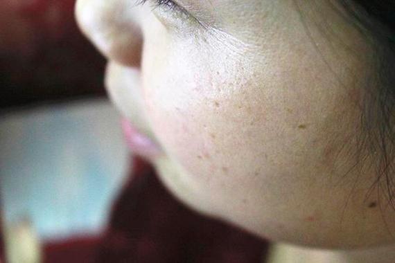 心肌损伤是什么病 如何确定是心肌损伤 心肌损伤是什么病 如何确定是心肌损伤