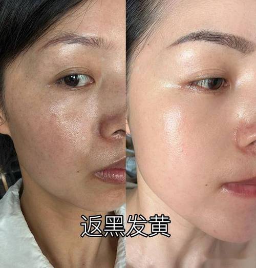 肥厚性心肌病能治好吗 肥厚性心肌病能治好吗