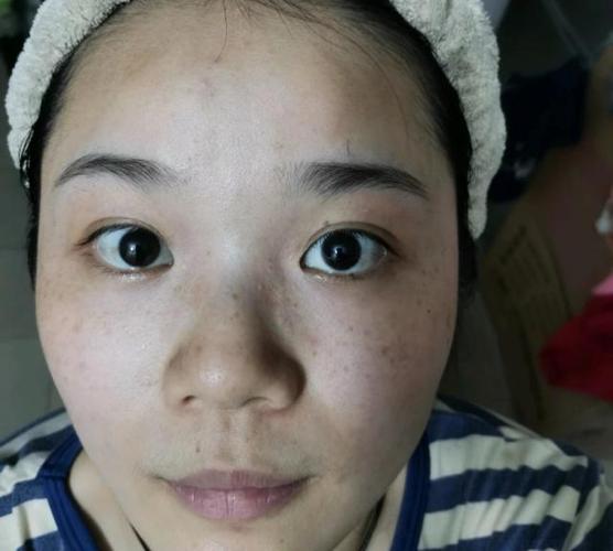 老人患了帕金综合症该怎么治疗? 老人患了帕金综合症该怎么治疗?